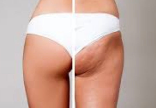 Cellulite 360 (6 sessions)