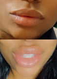 Lip filler
