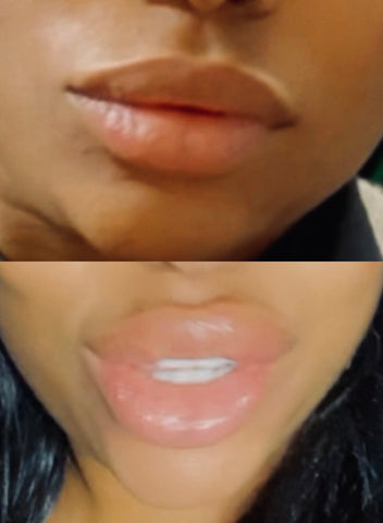 Lip filler