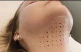 Lipo shot double chin/jawline