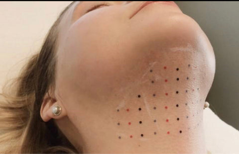 Lipo shot double chin/jawline