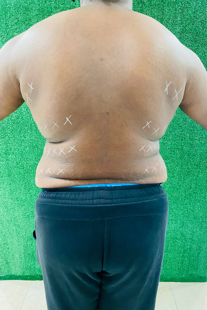 Back Liposuction: Back Fat Removal