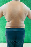 Lipo shots /back fat