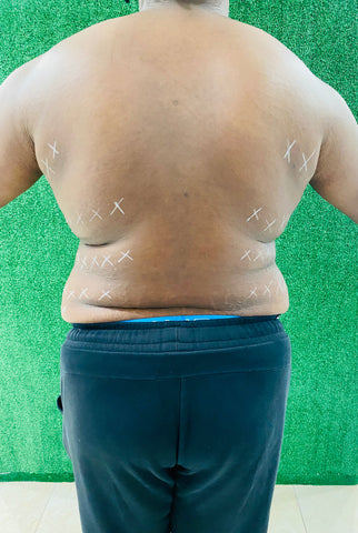 Lipo shots /back fat